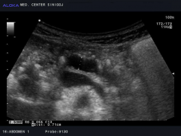 Ultrazvok trebuha - kronični kalcinirajoči pankreatitis, zgoraj razširjen pankreatični vod, spodaj vranična vena (v. lienalis)